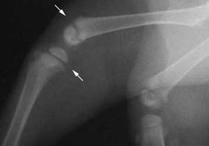 Strėlytės nuotraukoje rodo kaulų augimo zonas, kurių dėka kaulai ilgėja. Viršutinė strėlytė rodo šlaunikaulio (femur) galą, apatinė – blauzdikaulio (tibia) pradžią.